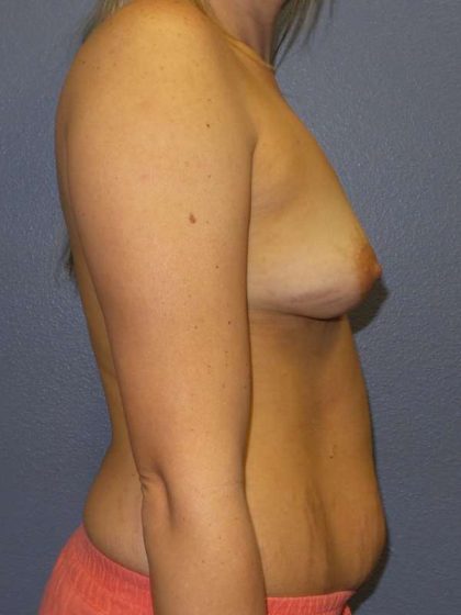 Breast Augmentation Before & After Patient #5542