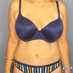 Abdominoplasty Before & After Patient #3338