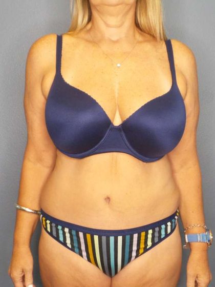 Abdominoplasty Before & After Patient #3338