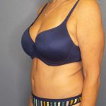 Abdominoplasty Before & After Patient #3338
