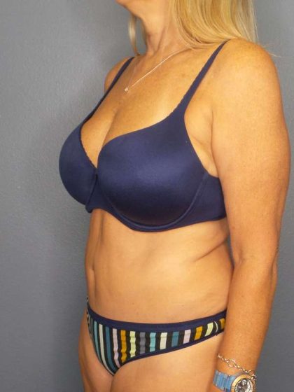 Abdominoplasty Before & After Patient #3338