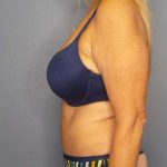Abdominoplasty Before & After Patient #3338