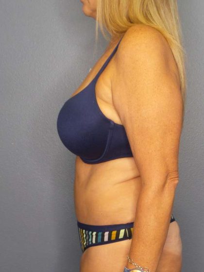Abdominoplasty Before & After Patient #3338