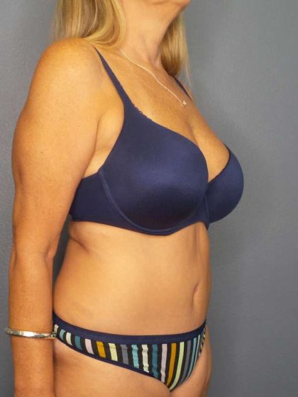 Abdominoplasty Before & After Patient #3338