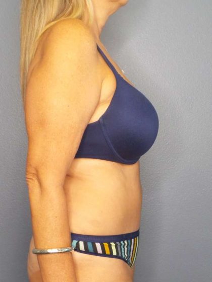Abdominoplasty Before & After Patient #3338