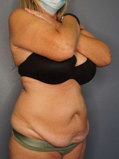 Abdominoplasty Before & After Patient #3338