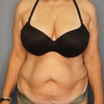 Abdominoplasty Before & After Patient #3338