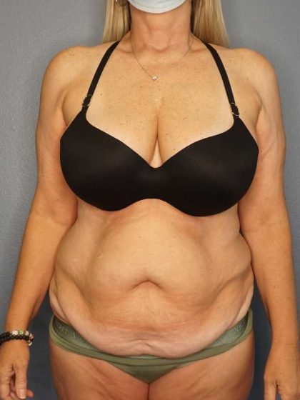 Abdominoplasty Before & After Patient #3338