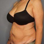 Abdominoplasty Before & After Patient #3338