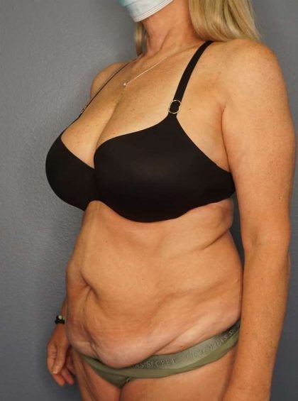 Abdominoplasty Before & After Patient #3338