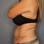 Abdominoplasty Before & After Patient #3338