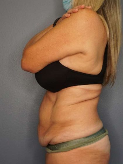 Abdominoplasty Before & After Patient #3338