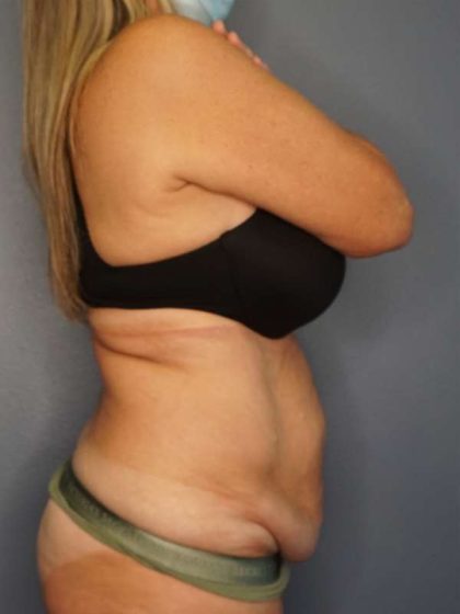 Abdominoplasty Before & After Patient #3338
