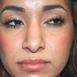 Revision Rhinoplasty Before & After Patient #11073