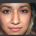 Revision Rhinoplasty Before & After Patient #11073