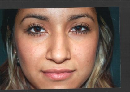 Revision Rhinoplasty Before & After Patient #11073