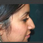 Revision Rhinoplasty Before & After Patient #11073