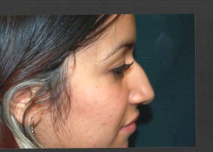 Revision Rhinoplasty Before & After Patient #11073
