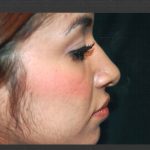 Revision Rhinoplasty Before & After Patient #11073