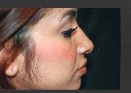 Revision Rhinoplasty Before & After Patient #11073