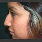 Revision Rhinoplasty Before & After Patient #11073