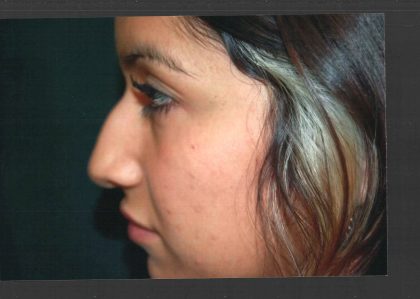 Revision Rhinoplasty Before & After Patient #11073