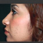 Revision Rhinoplasty Before & After Patient #11073