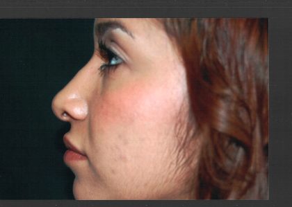 Revision Rhinoplasty Before & After Patient #11073