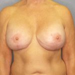 Breast Augmentation Revision (Breast Enlargement Repair) Before & After Patient #6958
