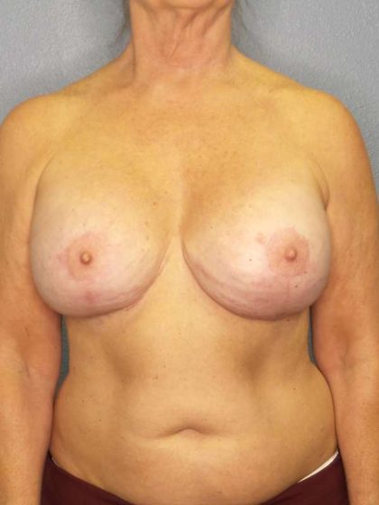 Breast Augmentation Revision (Breast Enlargement Repair) Before & After Patient #6958