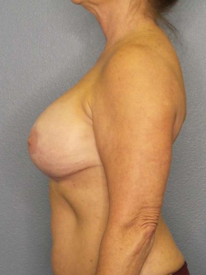 Breast Augmentation Revision (Breast Enlargement Repair) Before & After Patient #6958