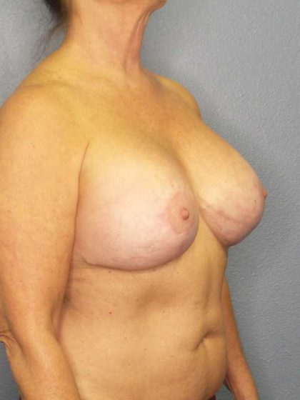 Breast Augmentation Revision (Breast Enlargement Repair) Before & After Patient #6958