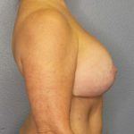 Breast Augmentation Revision (Breast Enlargement Repair) Before & After Patient #6958