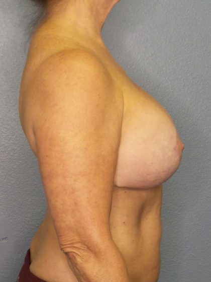 Breast Augmentation Revision (Breast Enlargement Repair) Before & After Patient #6958