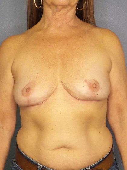 Breast Augmentation Revision (Breast Enlargement Repair) Before & After Patient #6958