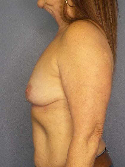 Breast Augmentation Revision (Breast Enlargement Repair) Before & After Patient #6958