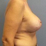 Augmentation Mastopexy Revision Before & After Patient #4735