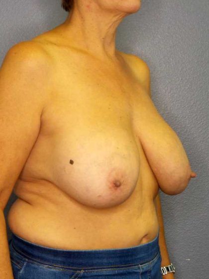 Augmentation Mastopexy Revision Before & After Patient #4735