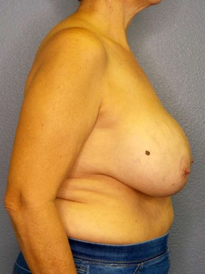 Augmentation Mastopexy Revision Before & After Patient #4735