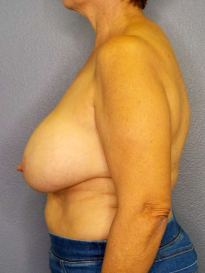 Augmentation Mastopexy Revision Before & After Patient #4735