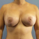 Augmentation Mastopexy Revision Before & After Patient #4724