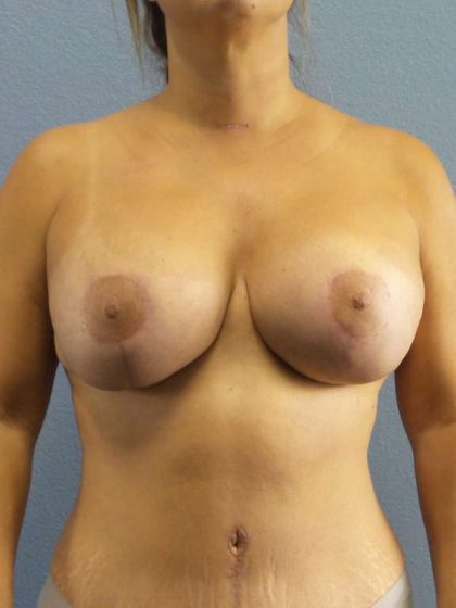 Augmentation Mastopexy Revision Before & After Patient #4724