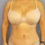 Abdominoplasty Before & After Patient #3654