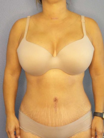 Abdominoplasty Before & After Patient #3654