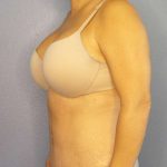 Abdominoplasty Before & After Patient #3654