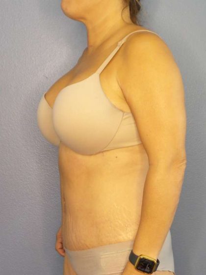 Abdominoplasty Before & After Patient #3654