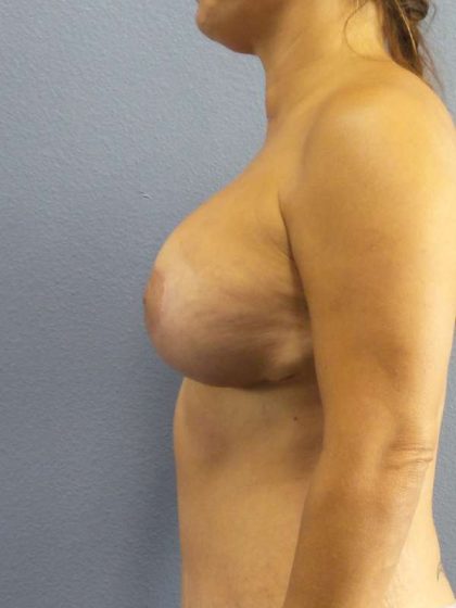 Augmentation Mastopexy Revision Before & After Patient #4724