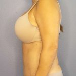 Abdominoplasty Before & After Patient #3654