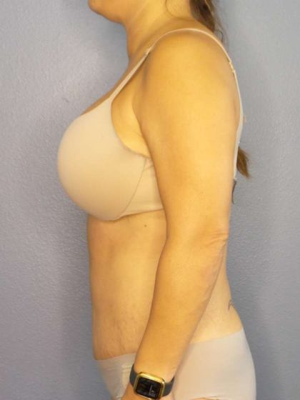 Abdominoplasty Before & After Patient #3654