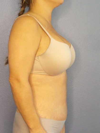 Abdominoplasty Before & After Patient #3654